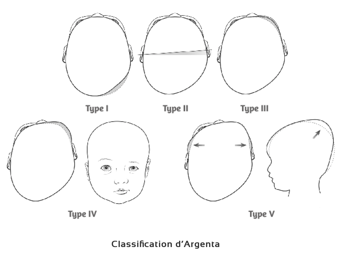 Comment Soigner la Plagiocéphalie : Tête Plate de Bébé