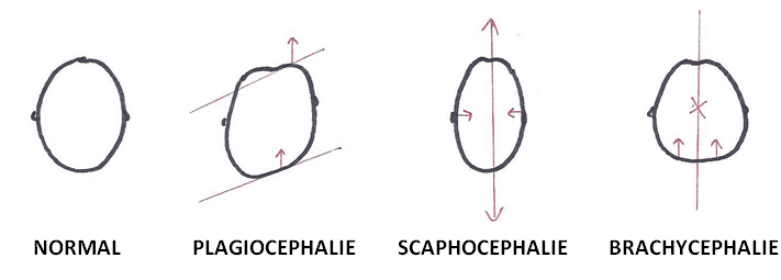 découvrez ce qu'est la plagiocéphalie du nourrisson : causes, conséquences, méthodes de prévention et traitements pour favoriser un développement crânien harmonieux de votre bébé.